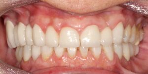 Rehabilitación integral, cirugía periodontal de alargamiento, coronas de circonio, reconstrucciones estéticas e implantes