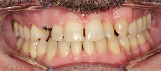 TTO interdisciplinar, ortodoncia, implantes y carillas estéticas
