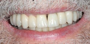 Rehabilitación periodontal, implantes y prótesis